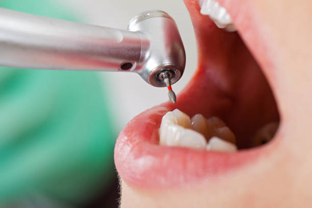 Best Emergency Wisdom Teeth Removal in Warm Springs, OR